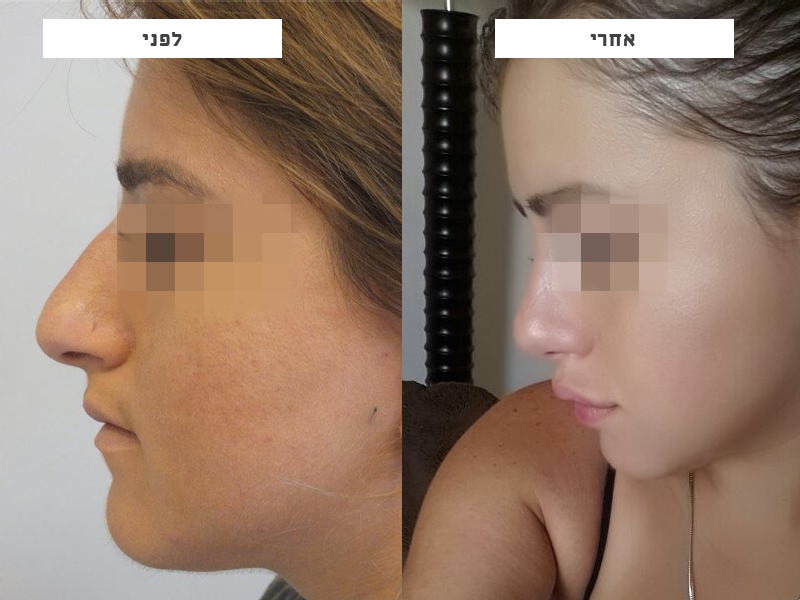 ניתוח פלסטי באף