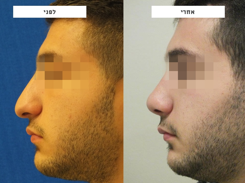 ניתוח פלסטי באף